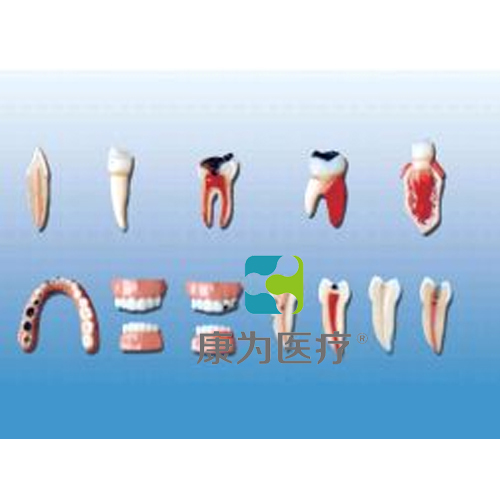 “康為醫療”牙齒病變系列模型