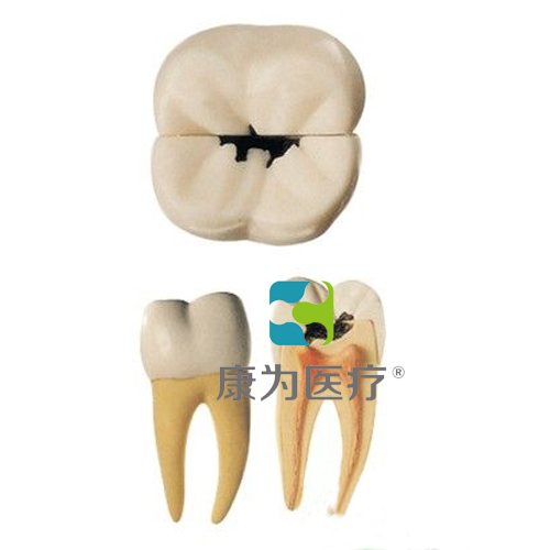 “康為醫療”磨牙蛀牙模型